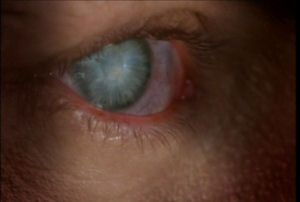Lester's eye turns completely blue