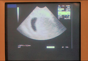 Ultrasound scan screen